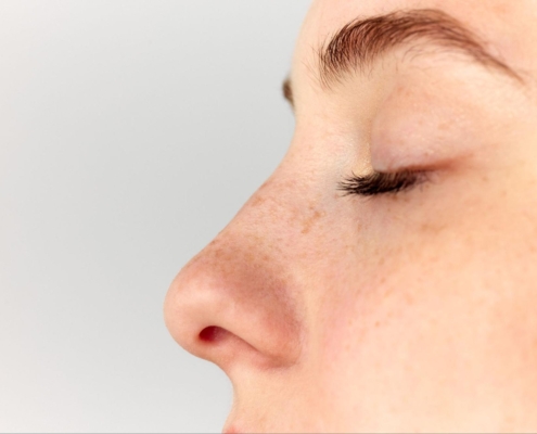 Are You a Good Candidate for the Awake Rhinoplasty?