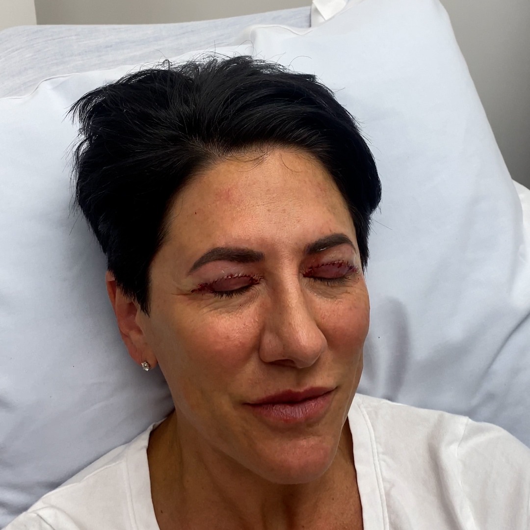 Patient recovering from blepharoplasty procedure, showcasing eyelid sutures and post-operative swelling, highlighting Dr. Michael Bassiri-Tehrani's eye rejuvenation expertise in New York.