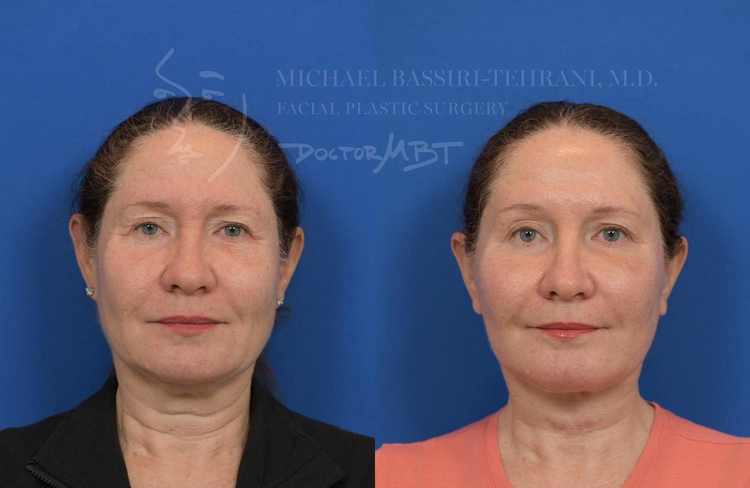 Front view Endoscopic Facelift NYC Before and After Front view Endoscopic Facelift NYC Before and After