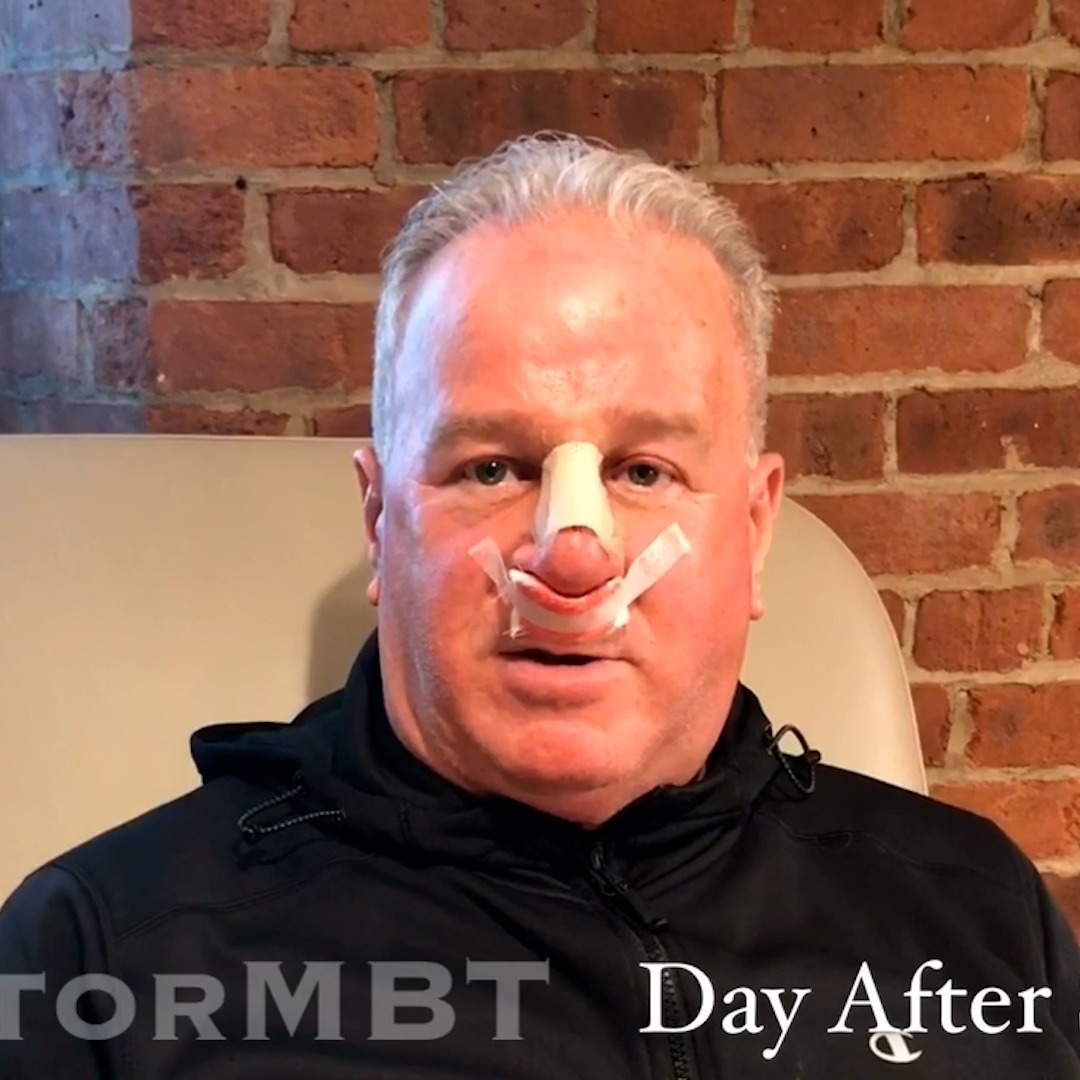 Man recovering after functional rhinoplasty, wearing a nasal splint, showcasing immediate post-operative results from Dr. Michael Bassiri-Tehrani, a top facial plastic surgeon in New York.