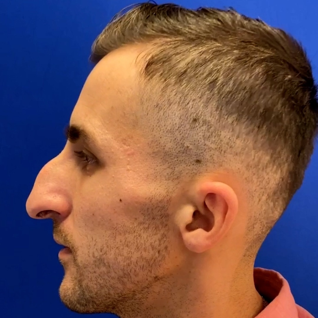 Profile view of a male patient post-functional rhinoplasty, showcasing nasal contour improvements, performed by Dr. Michael Bassiri-Tehrani, specialist in facial plastic surgery in New York.