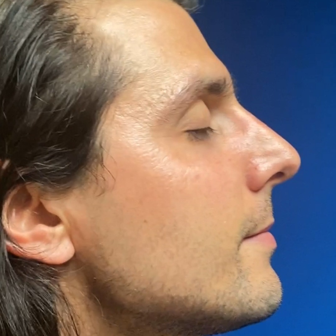 Profile view of a man showcasing results of functional rhinoplasty, highlighting nasal structure and facial contours, relevant to Dr. Michael Bassiri-Tehrani's expertise in rhinoplasty in New York.