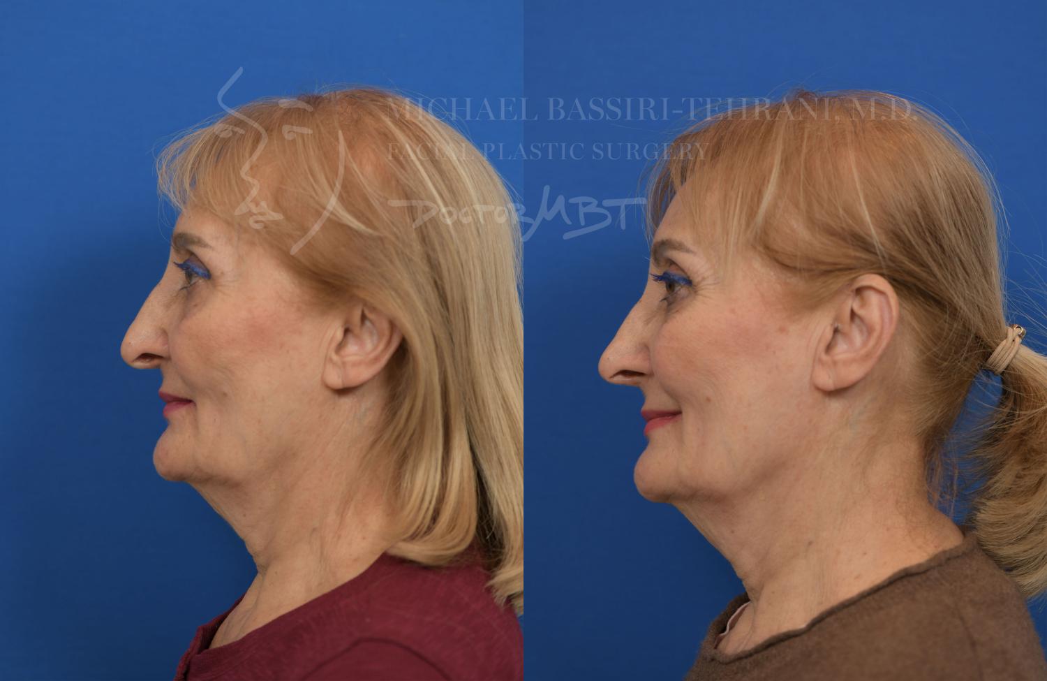 Before and after images of a patient showcasing the results of Tip Stitch Rhinoplasty by Dr. Michael Bassiri-Tehrani, highlighting facial profile changes and improvements in nasal aesthetics in New York.